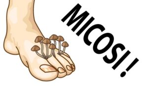 Immagine illustrativa: micosi